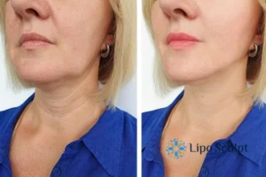 Double chin before and after Hi-Fu treatment 4 Book your double chin treatment Hatfield today! We are here to help!