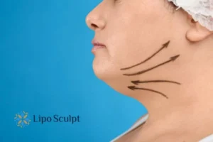 Double chin before and after Hi-Fu treatment 3 Boost your confidence with a Double chin treatment Hatfield