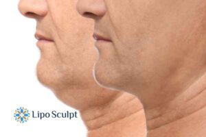 Double chin before and after Hi-Fu treatment 2 Double chin treatment Hatfield from Lipo Sculpt - feel more confident today!