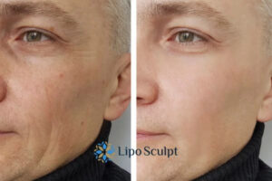 How to Fight Aging Symptoms 3 Fight Aging Symptoms Hatfield With HIFU and Morpheus8 Today!