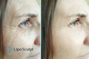 How to Fight Aging Symptoms 2 Do you want to Fight Aging Symptoms Hatfield? Contact Lipo Sculpt today!