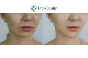 Explaining Total Skin Tightening Treatment And What It Can Do For You 2 Do you want to boost your self confidence? Give Morpheus8 Hatfield a try today!