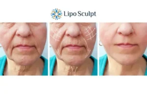 Explaining Total Skin Tightening Treatment And What It Can Do For You 3 Boost your confidence with Morpheus8 Hatfield call our team today!