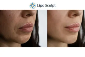 Explaining Total Skin Tightening Treatment And What It Can Do For You 4 Morpheus8 Hatfield the best results - call our team today!