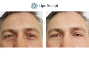 Explaining Total Skin Tightening Treatment And What It Can Do For You 6 Morpheus8 Hatfield book in today to find out more!