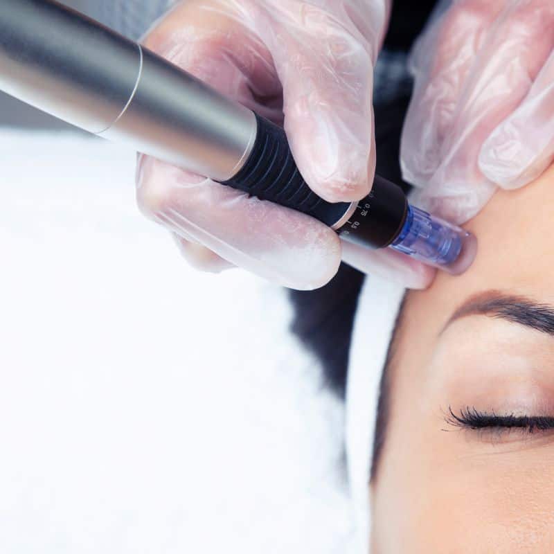 Morpheus8 treatment Hatfield from Lipo Sculpt - Book in today!