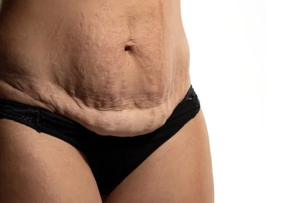 Lost the Weight but Not the Loose Skin? 1 image of womans stomach after weight loss showing loose skin Hatfield